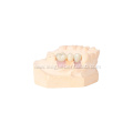 Implant Restoration Porcelain Dental Crowns